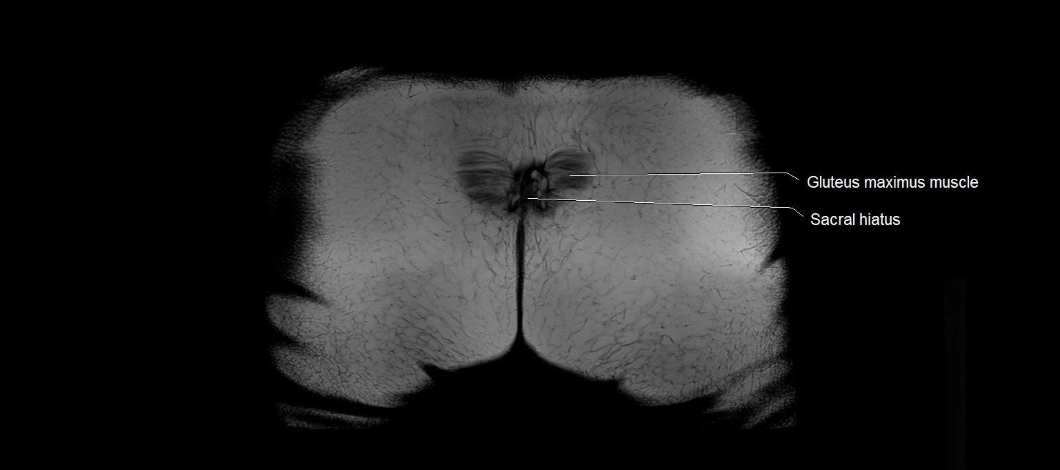 MRI 3T pelvis coronal cross section anatomy image 30.webp